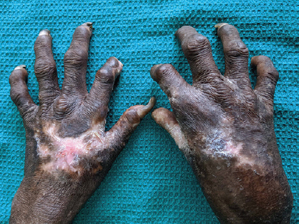 Clinical photograph demonstrating shortening of fingers and mutilating scars over the hand.